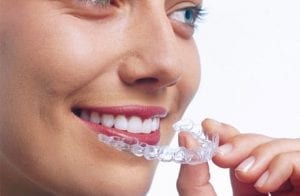 Adult Braces in Kingston