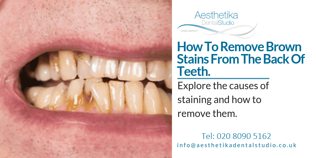 Remove Brown Stains From Teeth Kingston Aesthetika