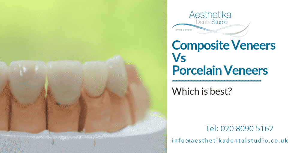 Composite Dental Veneers Kingston