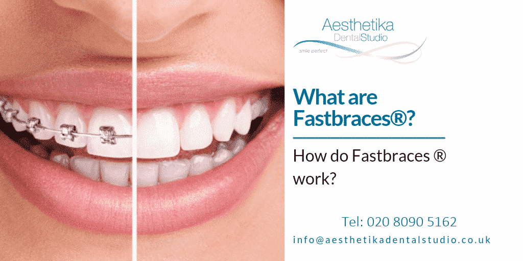 What Are Fastbraces Aesthetika Dental Studio