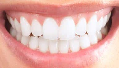 Teeth Whitening Home Kit Kingston