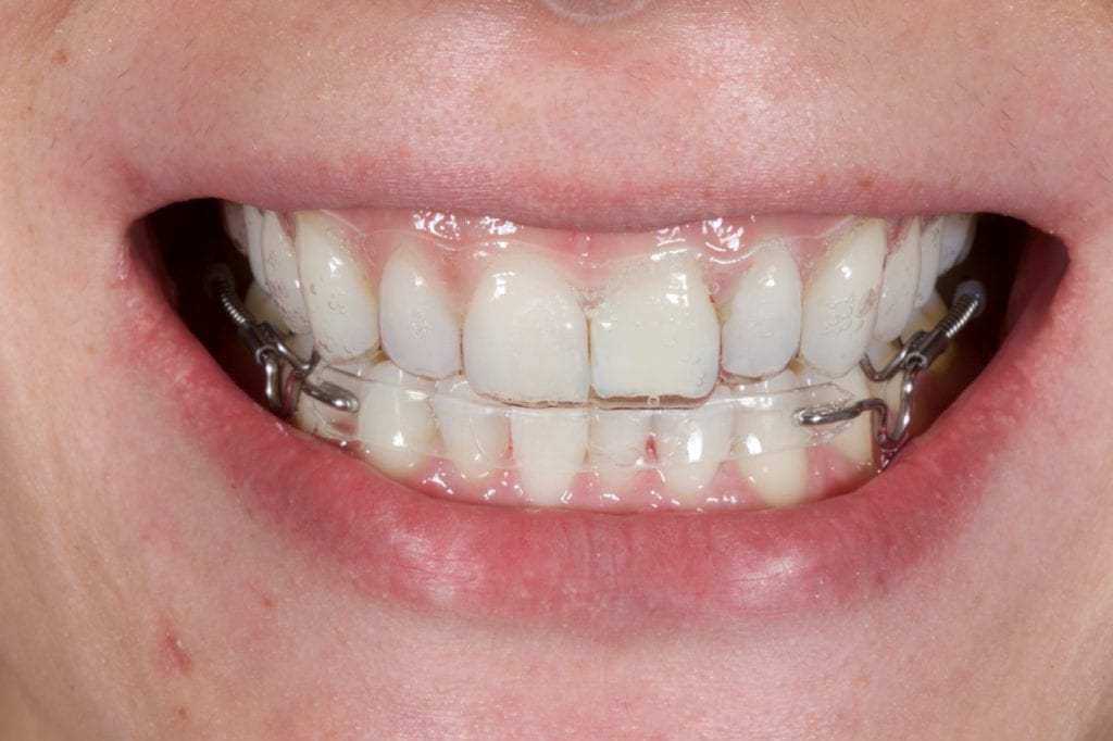 Inman Aligner Kingston
