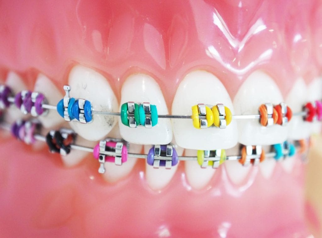Metal Braces Offer Kingston
