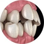 Composite Bonding for Crowded & Misaligned Teeth