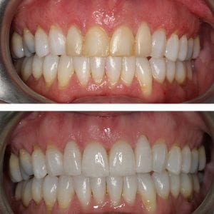 Veneers Kingston upon Thames