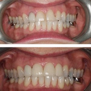 Veneers in Kingston upon Thames