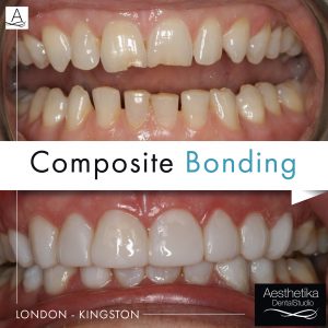 what is composite bonding