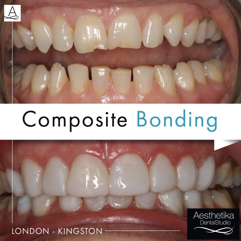 what is composite bonding