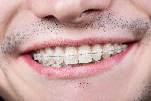 Man Smiling Showing Orthodontic Fast Braces Treatment in Kingston