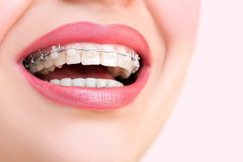 Lady Smiling after Having Orthodontic Fast Braces in Kingston