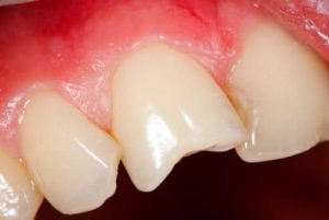 Broken Teeth Treated by Emergency Dentist in Kingston upon Thames