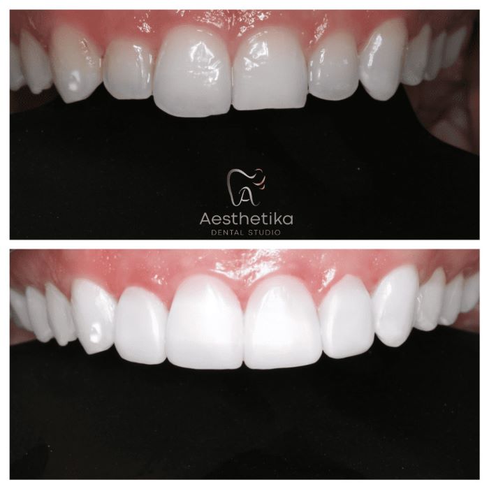 Composite Bonding Before and After Treatment