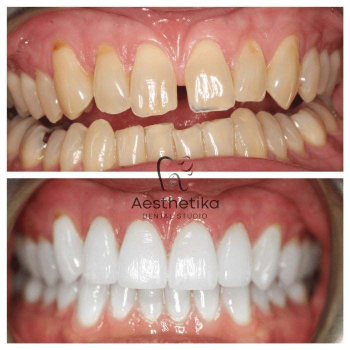 Composite Dental Bonding For Gaps Before and After Makeover