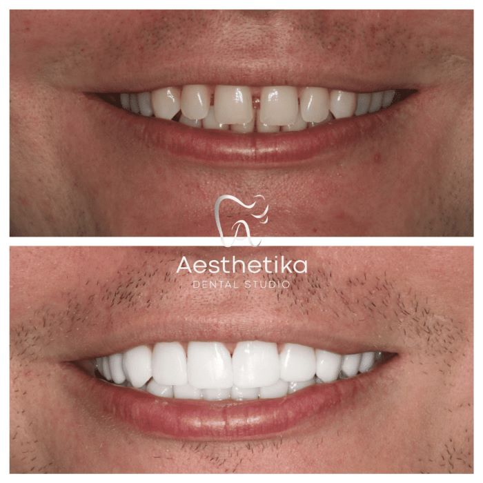 Dental Bonding Before and After Treatment