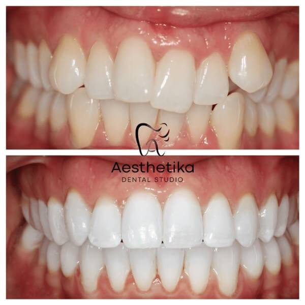 Invisalign Dental Aligners Kingston upon Thames