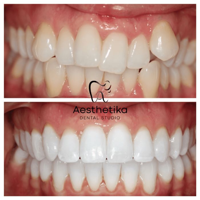 Invisalign Treatment Before and After in Kingston