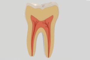 Emergency Root Canal Treatment