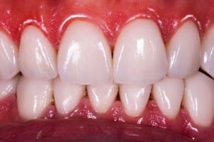 Swollen Gums