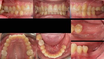 Dental Implant Case Kingston Upon Thames DL1