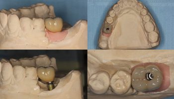 Dental Implant Case Kingston Upon Thames DL2