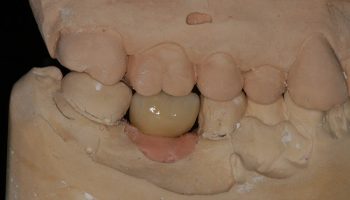Dental Implant Case Kingston Upon Thames JB2