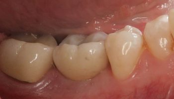 Dental Implant Case Kingston Upon Thames JB3