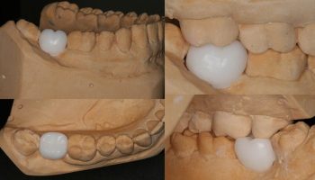 Dental Implant Case Kingston Upon Thames KW2