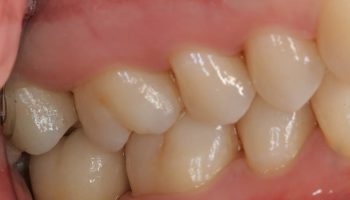 Dental Implant Case Kingston Upon Thames KW3