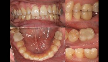 Dental Implant Restoration Kingston